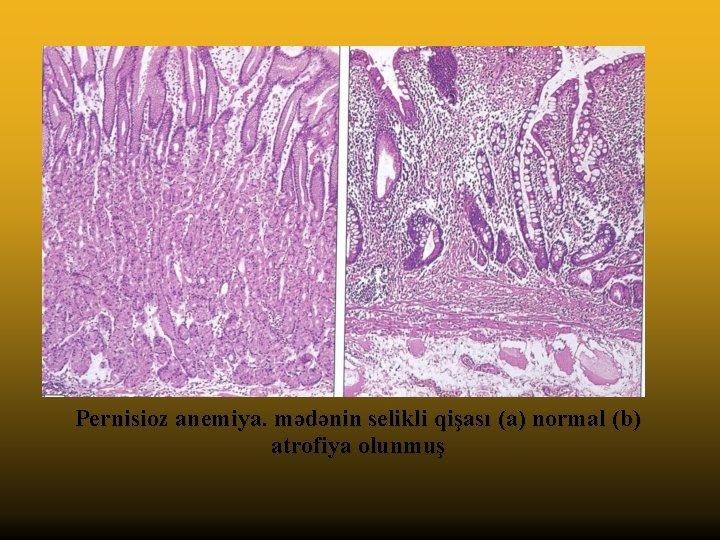 Pernisioz anemiya. mədənin selikli qişası (a) normal (b) atrofiya olunmuş 