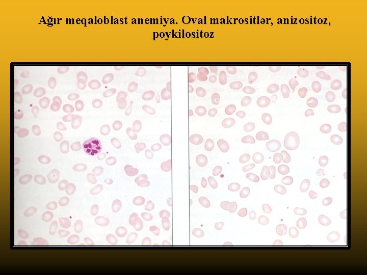 Ağır meqaloblast anemiya. Oval makrositlər, anizositoz, poykilositoz 