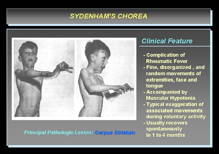 SYDENHAM’S CHOREA Clinical Feature Principal Pathologic Lesion: Corpus Striatum - Complication of Rheumatic Fever