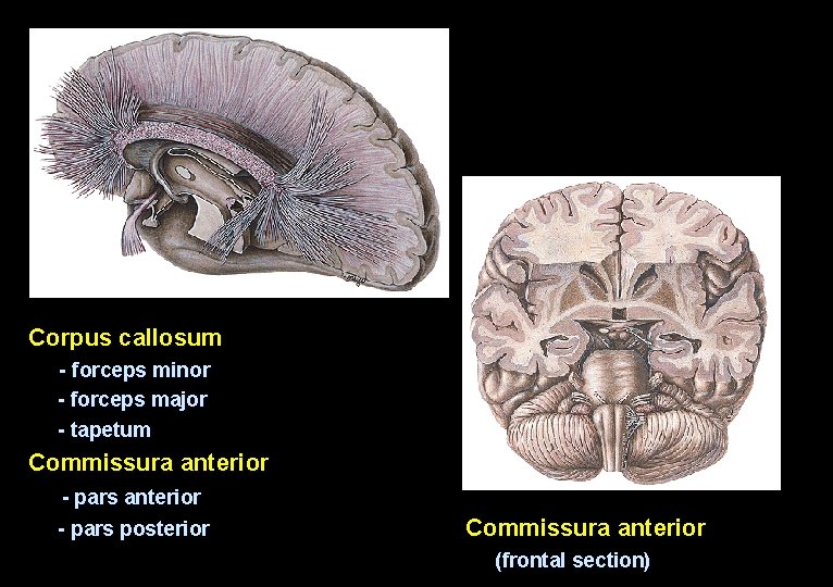 Corpus callosum - forceps minor - forceps major - tapetum Commissura anterior - pars