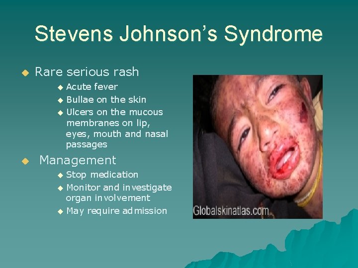 Stevens Johnson’s Syndrome u Rare serious rash Acute fever u Bullae on the skin