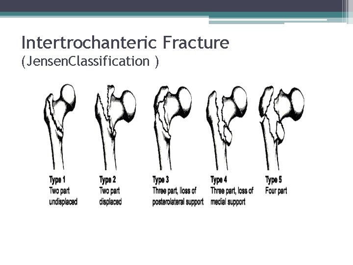 Intertrochanteric Fracture (Jensen. Classification ) 