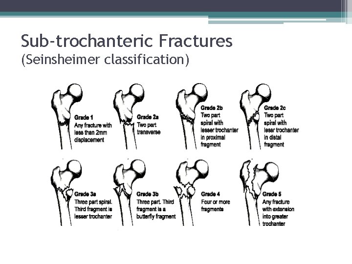 Sub-trochanteric Fractures (Seinsheimer classification) 