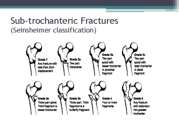 Sub-trochanteric Fractures (Seinsheimer classification) 