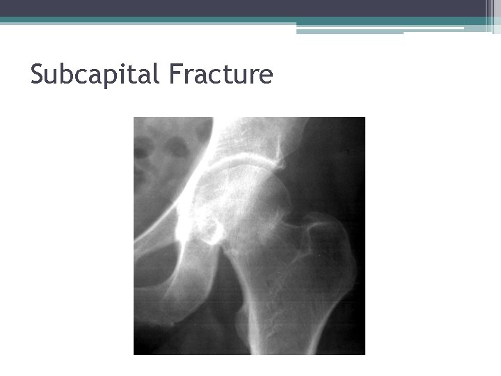 Subcapital Fracture 