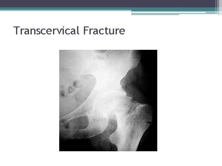 Transcervical Fracture 