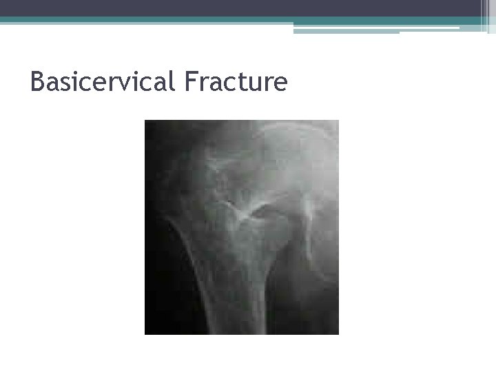 Basicervical Fracture 