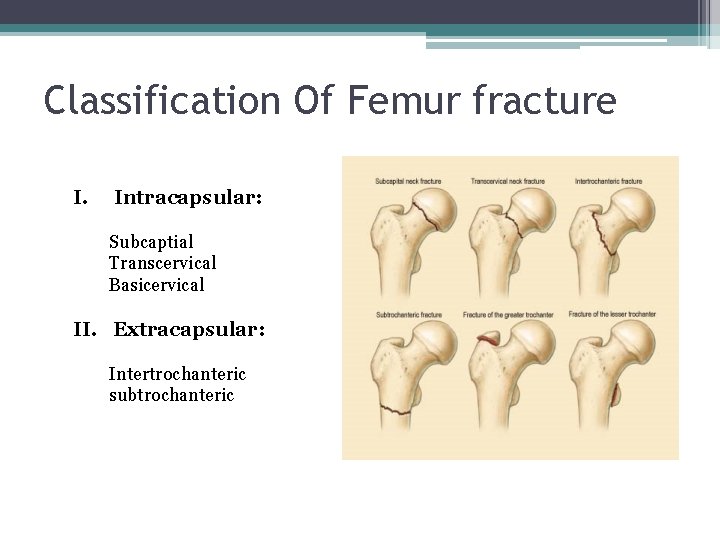 Classification Of Femur fracture I. Intracapsular: Subcaptial Transcervical Basicervical II. Extracapsular: Intertrochanteric subtrochanteric 