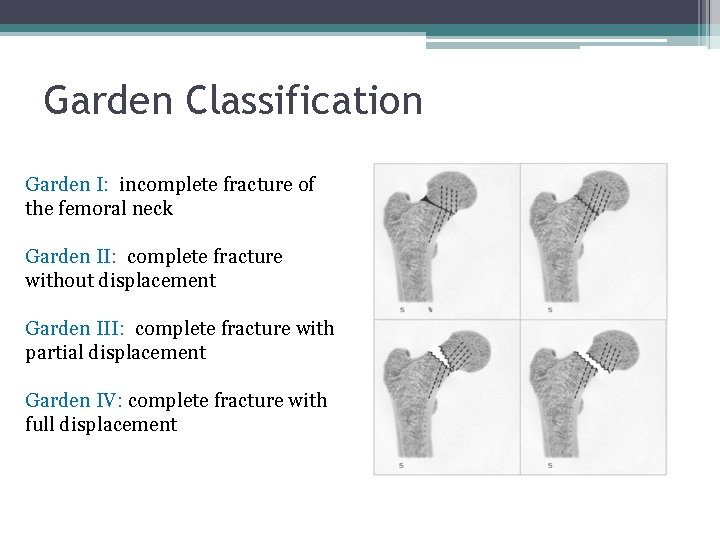 Garden Classification Garden I: incomplete fracture of the femoral neck Garden II: complete fracture