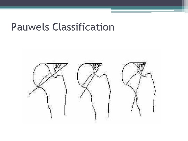 Pauwels Classification 