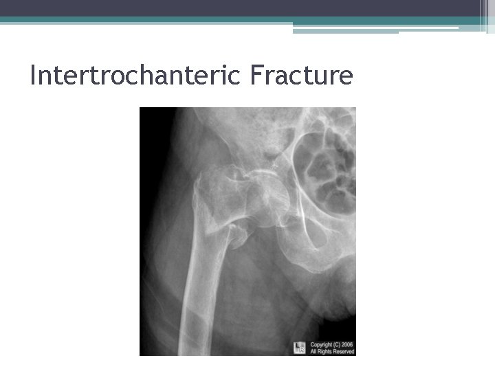 Intertrochanteric Fracture 