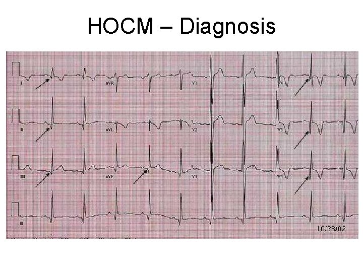 HOCM – Diagnosis  HOCM – Diagnosis