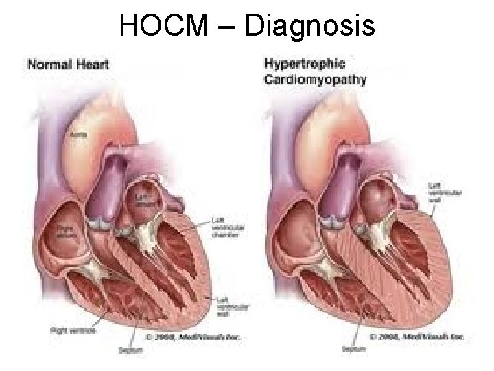 HOCM – Diagnosis  HOCM – Diagnosis