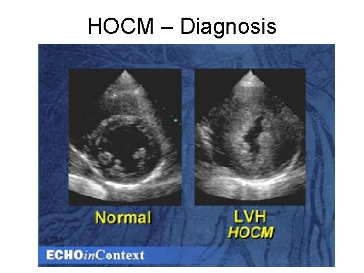 HOCM – Diagnosis  HOCM – Diagnosis