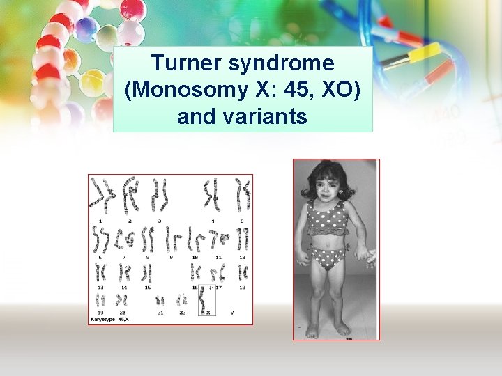 Turner syndrome (Monosomy X: 45, XO) and variants Turner syndrome (Monosomy X: 45, XO) and variants
