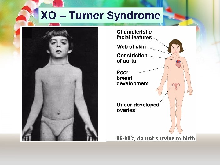 XO – Turner Syndrome 96 -98% do not survive to birth XO – Turner Syndrome 96 -98% do not survive to birth