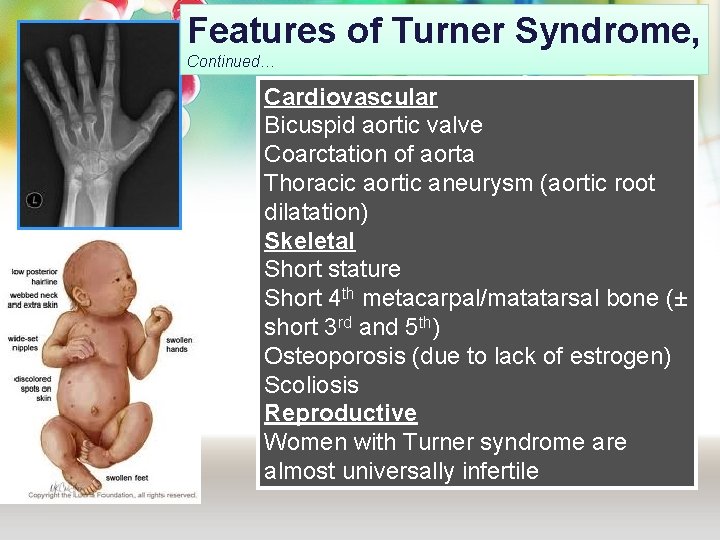 Features of Turner Syndrome, Continued… Cardiovascular Bicuspid aortic valve Coarctation of aorta Thoracic aortic Features of Turner Syndrome, Continued… Cardiovascular Bicuspid aortic valve Coarctation of aorta Thoracic aortic