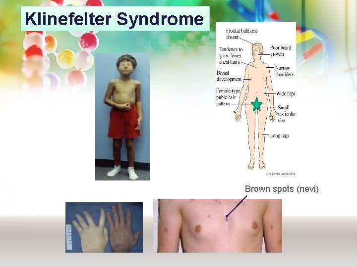 Klinefelter Syndrome Brown spots (nevi) Klinefelter Syndrome Brown spots (nevi)