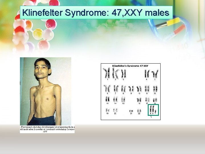 Klinefelter Syndrome: 47, XXY males Klinefelter Syndrome: 47, XXY males