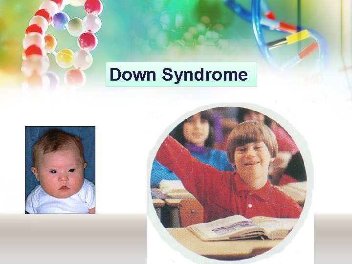 Down Syndrome Down Syndrome