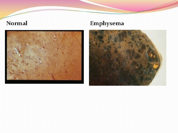 Normal Emphysema 