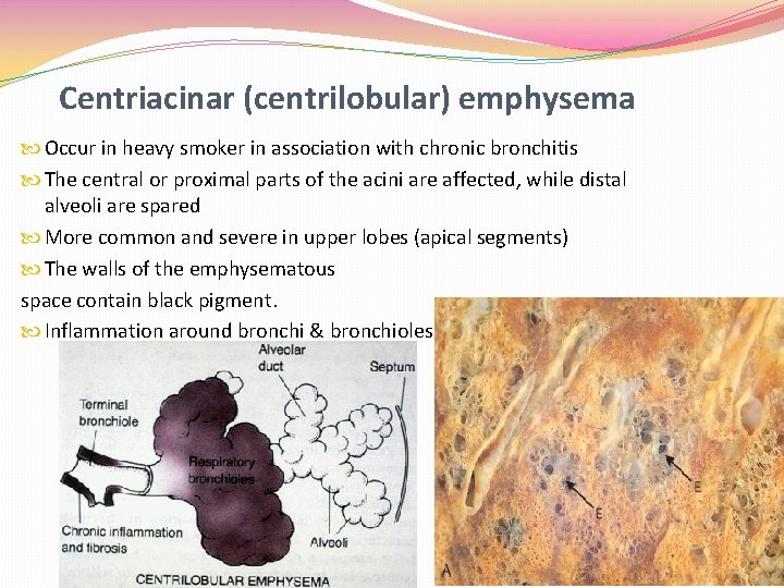 Centriacinar (centrilobular) emphysema Occur in heavy smoker in association with chronic bronchitis The central