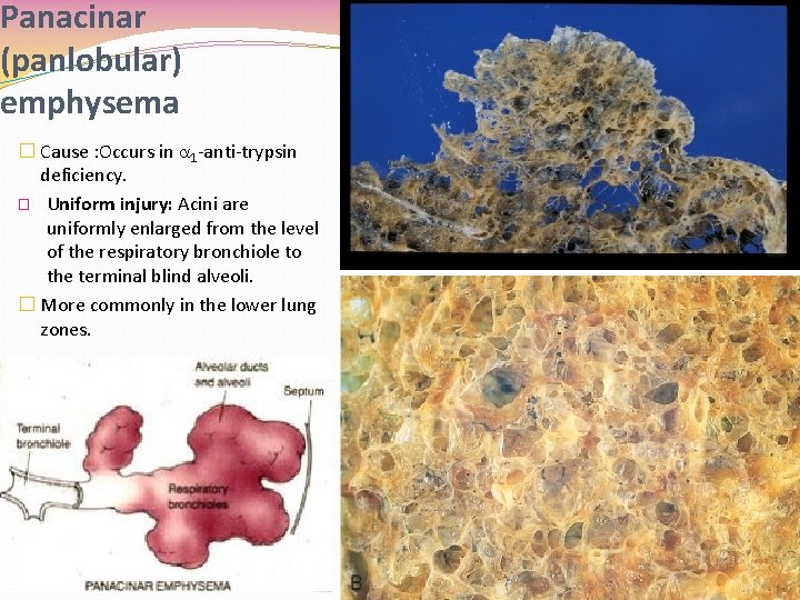 Panacinar (panlobular) emphysema � Cause : Occurs in 1 -anti-trypsin deficiency. � Uniform injury: