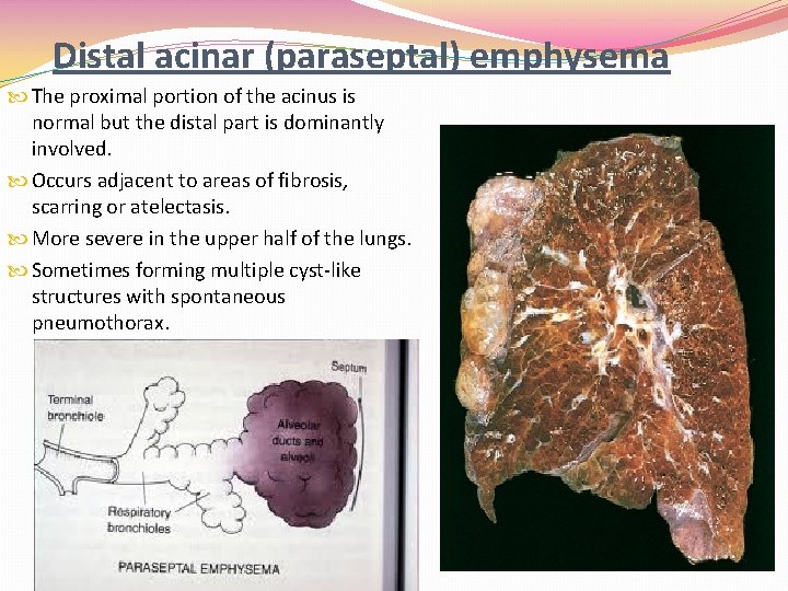 Distal acinar (paraseptal) emphysema The proximal portion of the acinus is normal but the