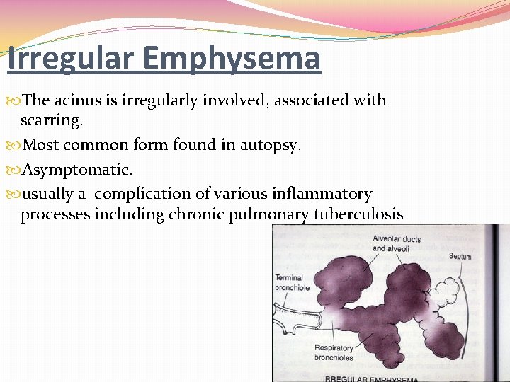 Irregular Emphysema The acinus is irregularly involved, associated with scarring. Most common form found