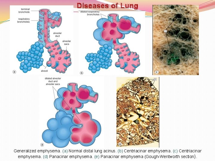 Diseases of Lung Generalized emphysema. (a) Normal distal lung acinus. (b) Centriacinar emphysema. (c)