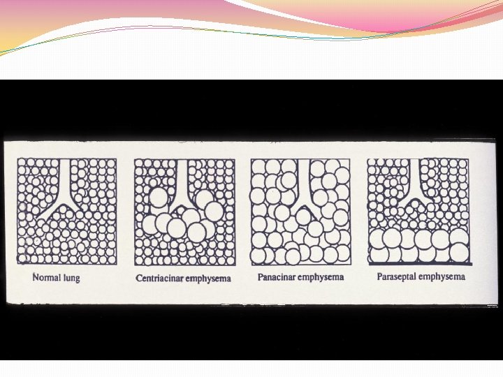 Loss of surface area (emphysema) 