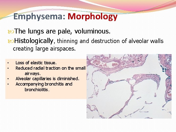 Emphysema: Morphology The lungs are pale, voluminous. Histologically, thinning and destruction of alveolar walls