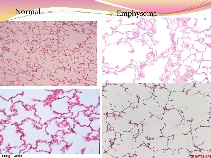  Normal Emphysema 