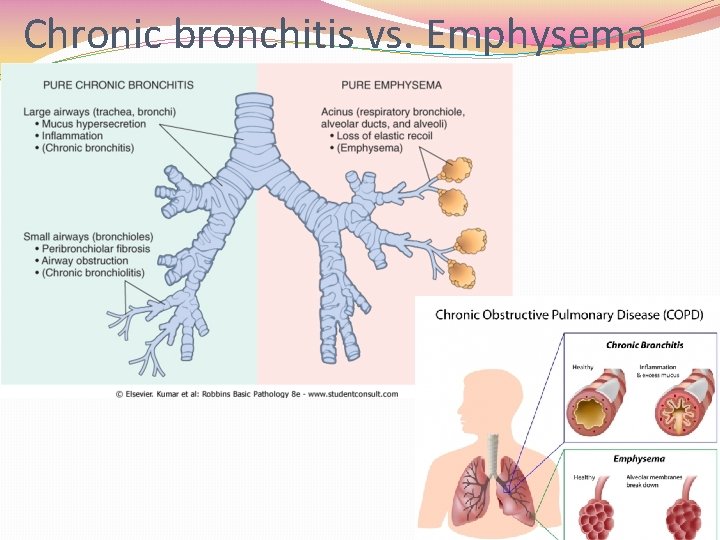Chronic bronchitis vs. Emphysema 