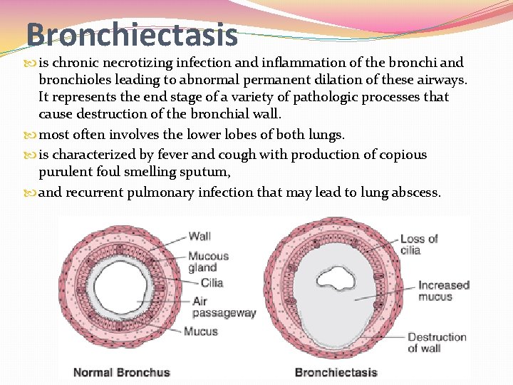 Bronchiectasis is chronic necrotizing infection and inflammation of the bronchi and bronchioles leading to