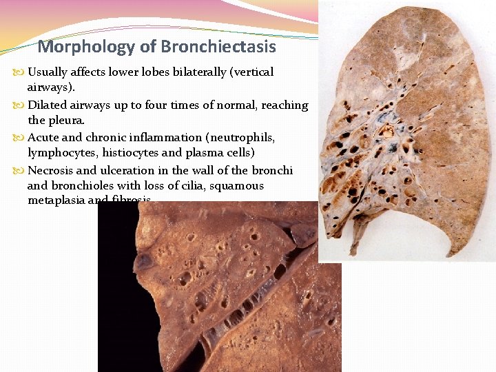 Morphology of Bronchiectasis Usually affects lower lobes bilaterally (vertical airways). Dilated airways up to