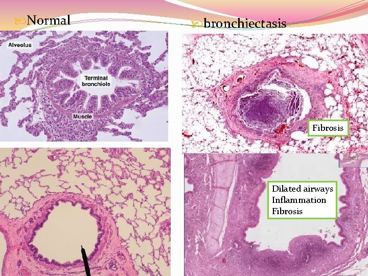  Normal bronchiectasis Fibrosis Dilated airways Inflammation Fibrosis 