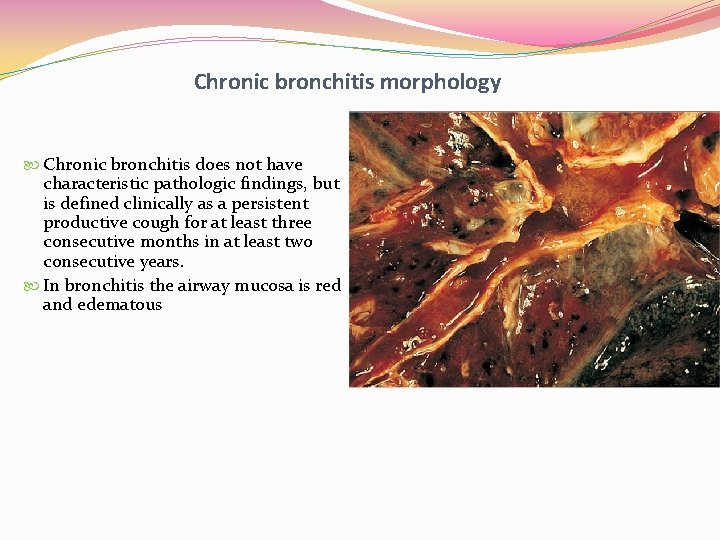 Chronic bronchitis morphology Chronic bronchitis does not have characteristic pathologic findings, but is defined