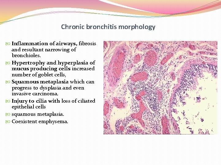 Chronic bronchitis morphology Inflammation of airways, fibrosis and resultant narrowing of bronchioles. Hypertrophy and