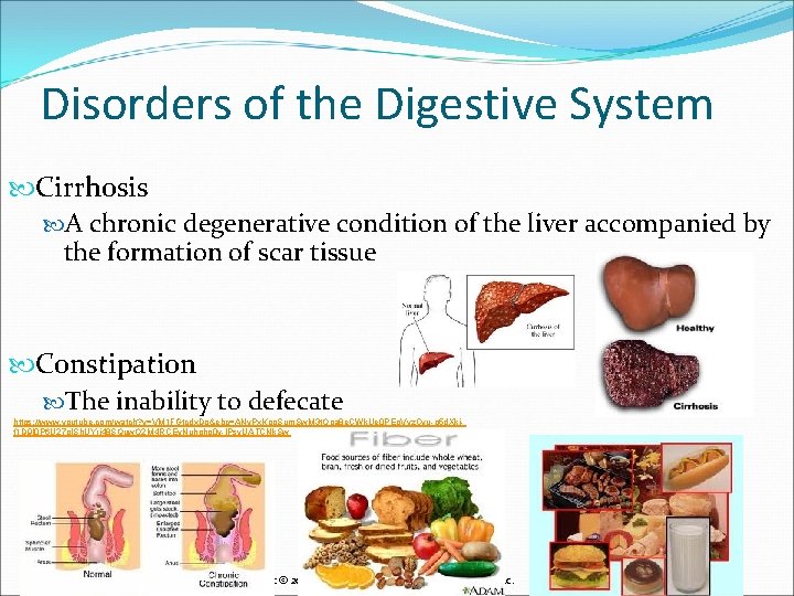 Disorders of the Digestive System Cirrhosis A chronic degenerative condition of the liver accompanied