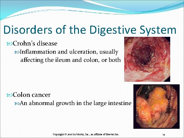 Disorders of the Digestive System Crohn’s disease Inflammation and ulceration, usually affecting the ileum