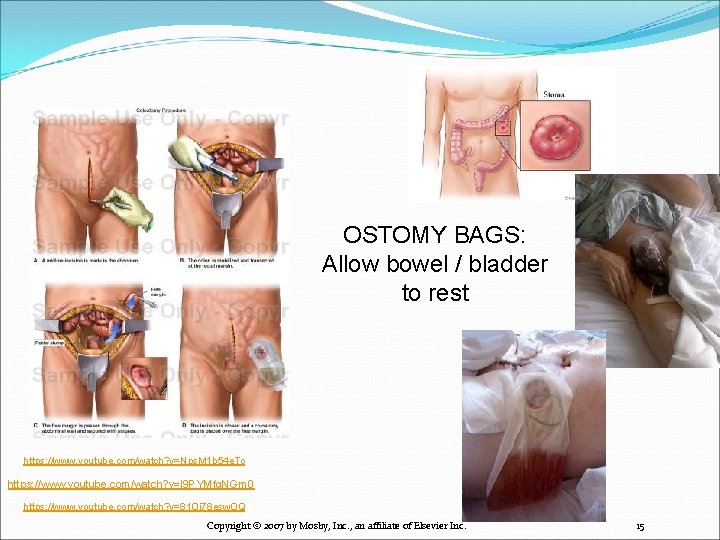 OSTOMY BAGS: Allow bowel / bladder to rest https: //www. youtube. com/watch? v=Nps. M