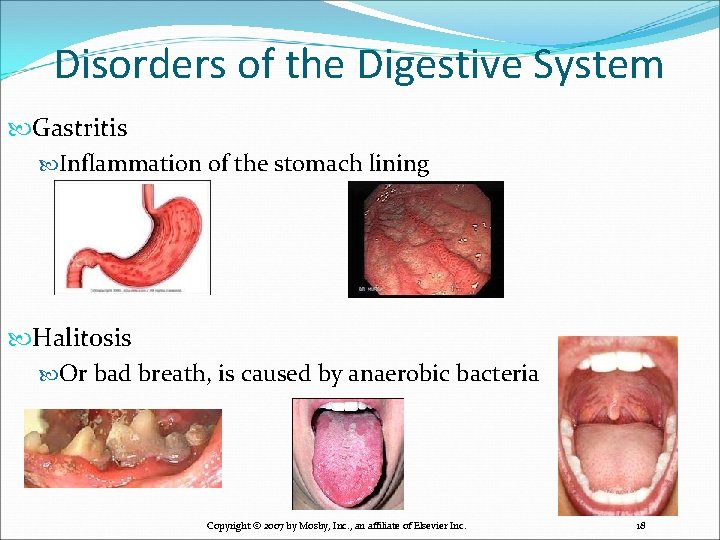 Disorders of the Digestive System Gastritis Inflammation of the stomach lining Halitosis Or bad