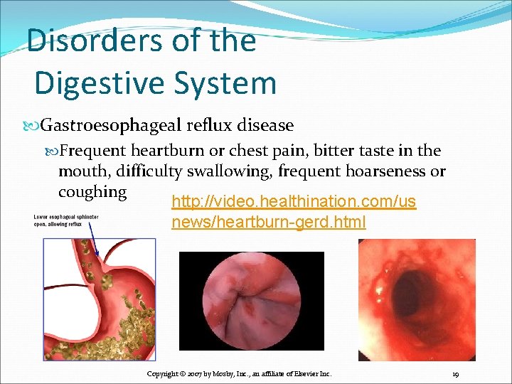 Disorders of the Digestive System Gastroesophageal reflux disease Frequent heartburn or chest pain, bitter