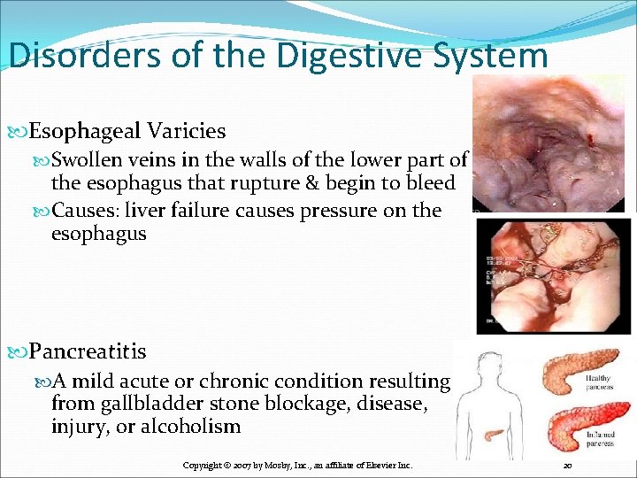 Disorders of the Digestive System Esophageal Varicies Swollen veins in the walls of the