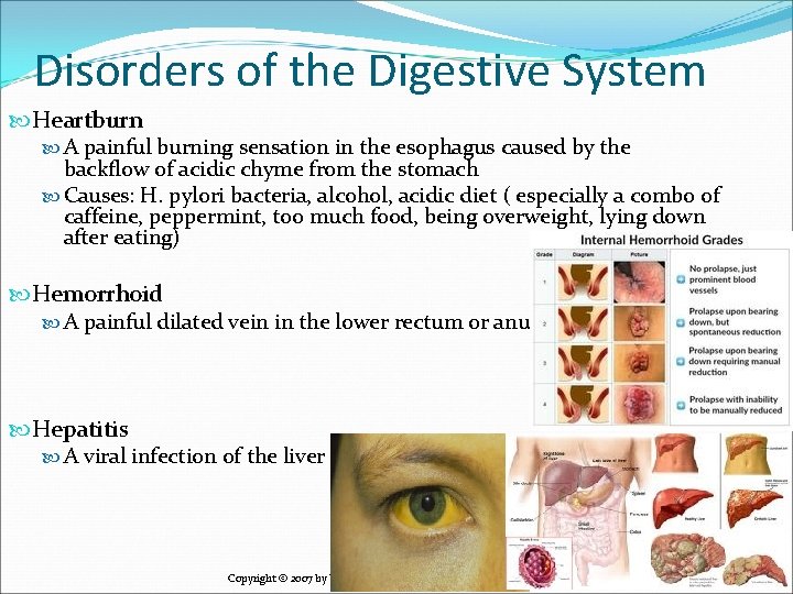 Disorders of the Digestive System Heartburn A painful burning sensation in the esophagus caused