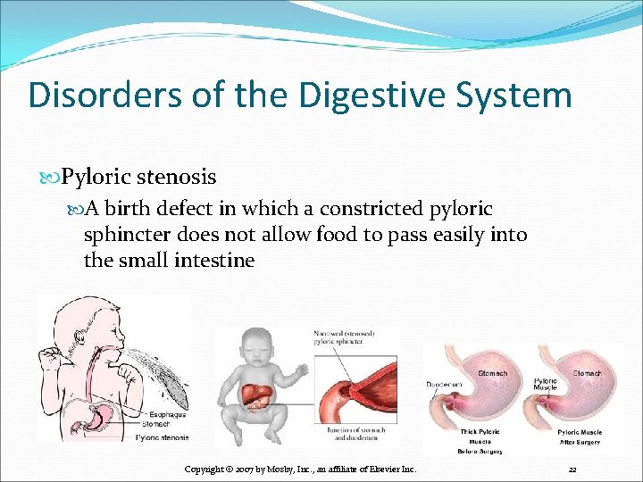 Disorders of the Digestive System Pyloric stenosis A birth defect in which a constricted