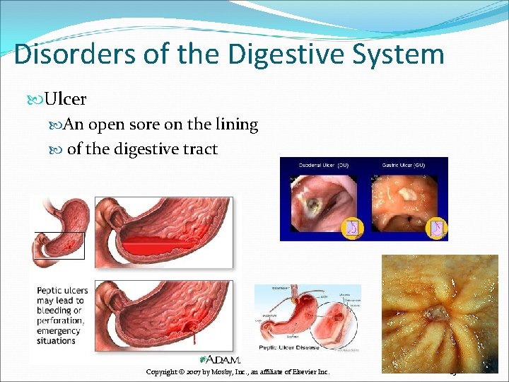 Disorders of the Digestive System Ulcer An open sore on the lining of the