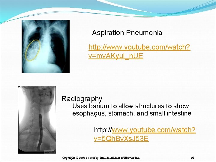 Aspiration Pneumonia http: //www. youtube. com/watch? v=mv. AKyu. I_n. UE Radiography Uses barium to