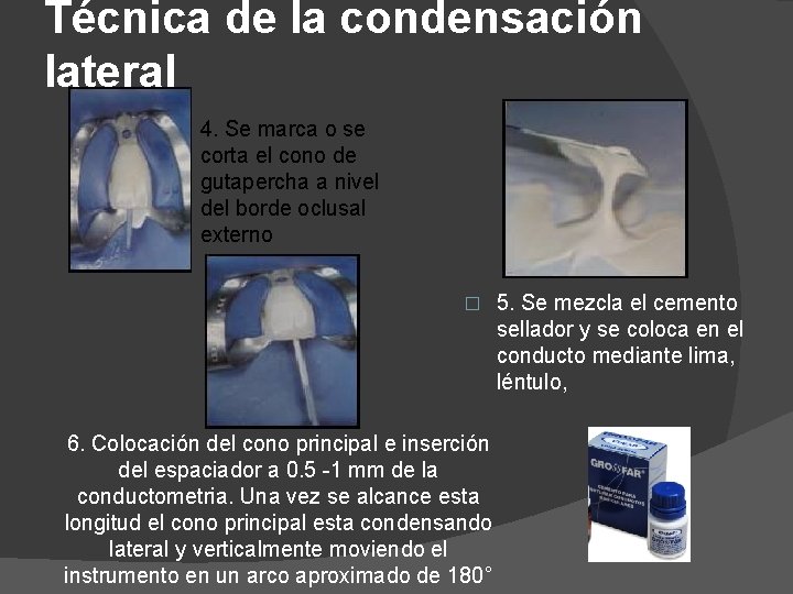 Técnica de la condensación lateral 4. Se marca o se corta el cono de